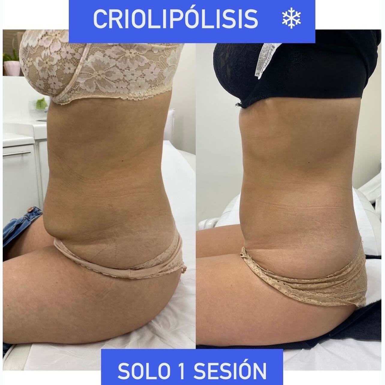 Cryolipolisis en Girona