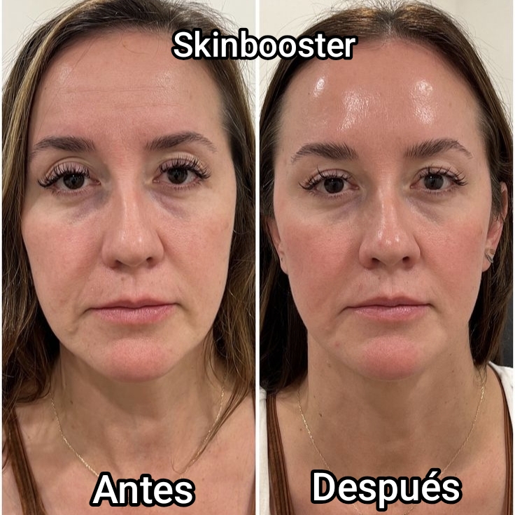 Antes y después de Skinboosters para mejorar hidratación textura y luminosidad en Bagira Sant Feliu de Guíxols