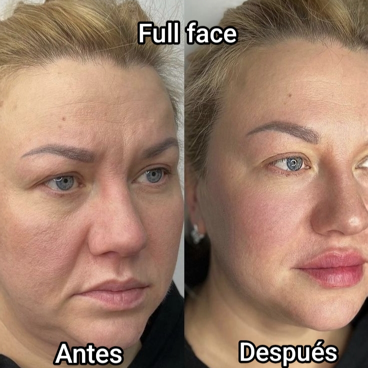Antes y después de Full Face para armonización facial en Bagira Sant Feliu de Guíxols