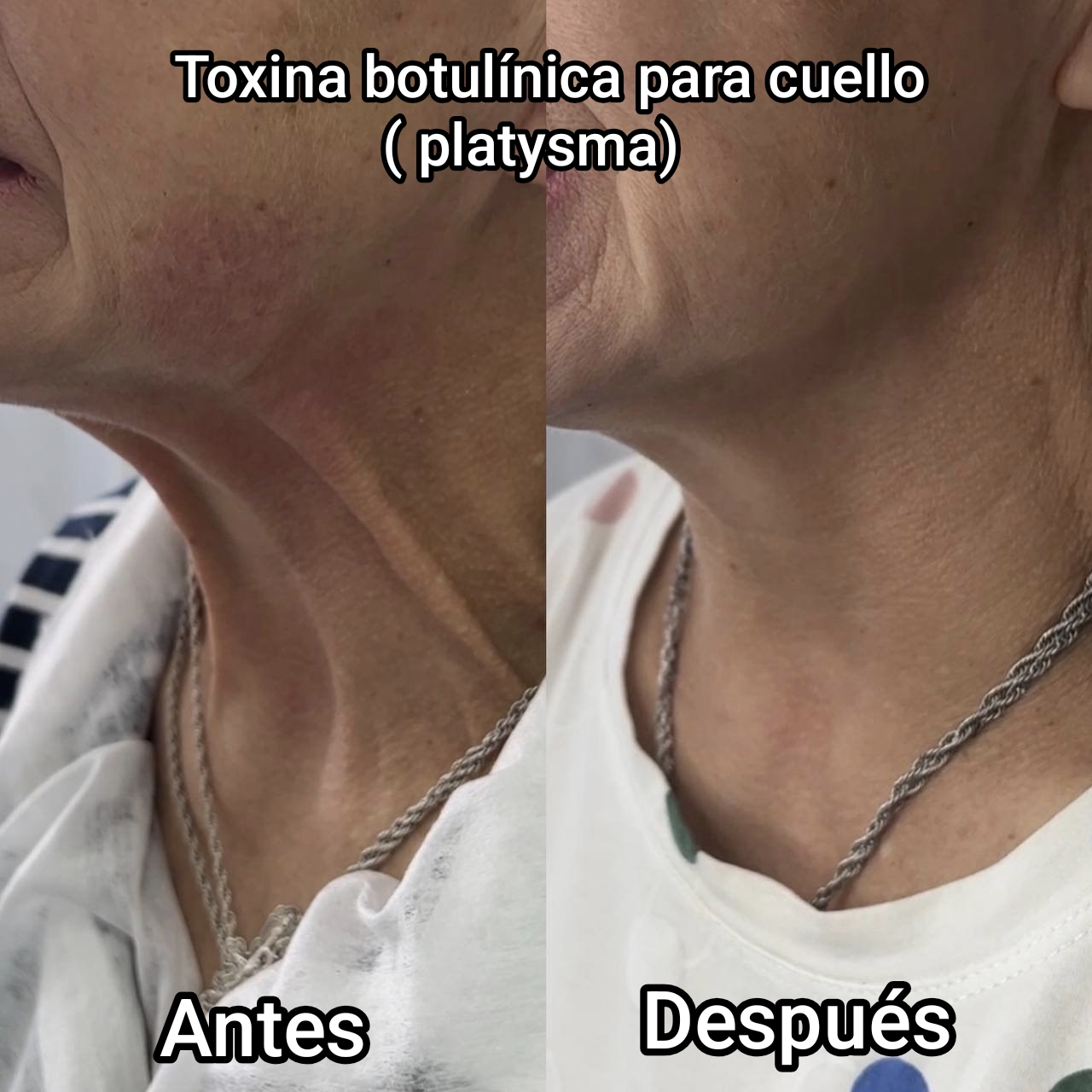 Antes y después de toxina botulínica para el platisma y cuello en Bagira Sant Feliu de Guíxols