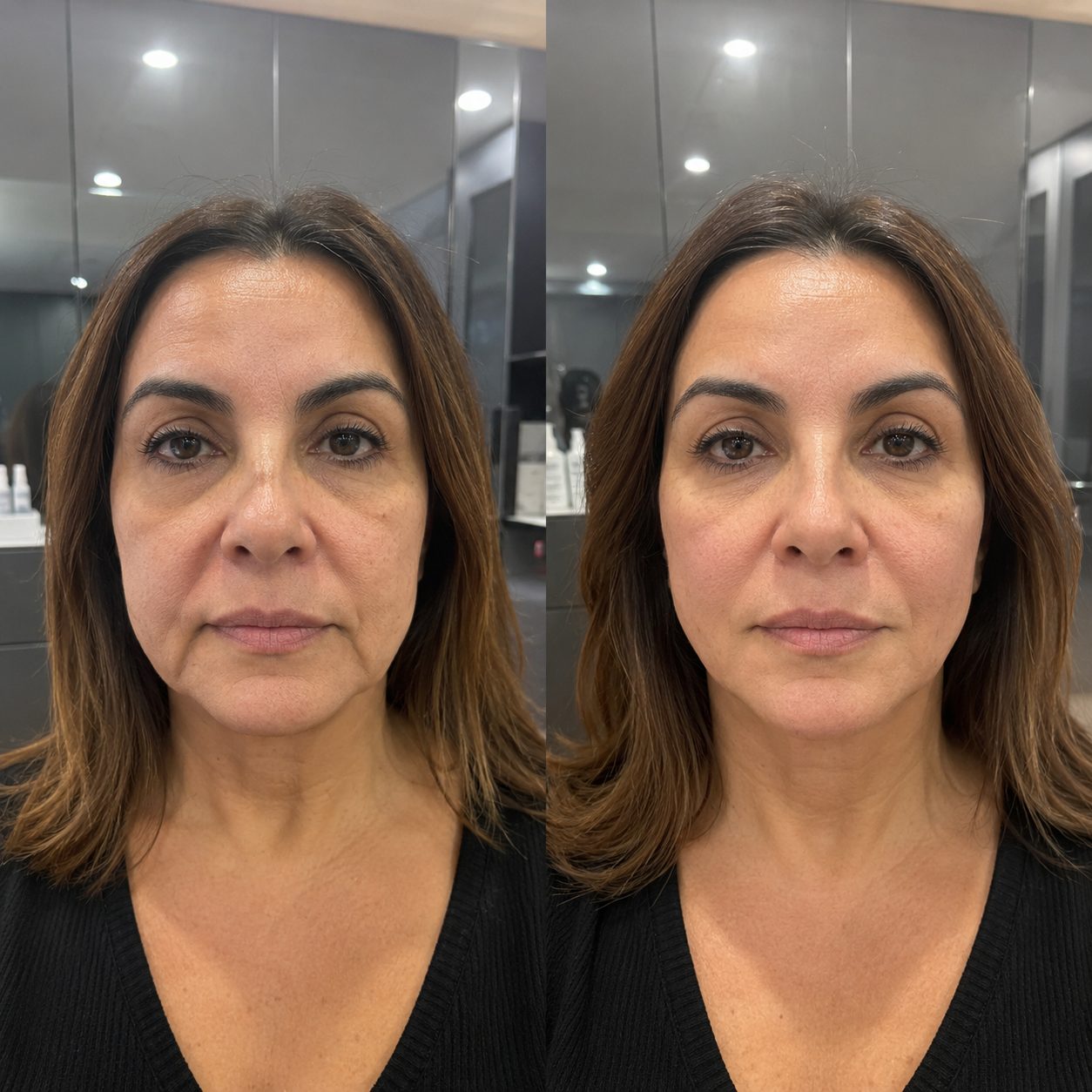 Antes y después de hilos tensores para óvalo facial en Bagira Sant Feliu de Guíxols