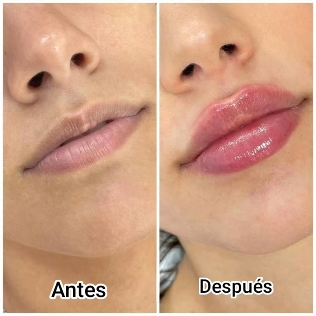 Aumento sutil + definición de contorno